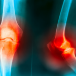 Can The Carnivore Diet Really Help Joint Pain?